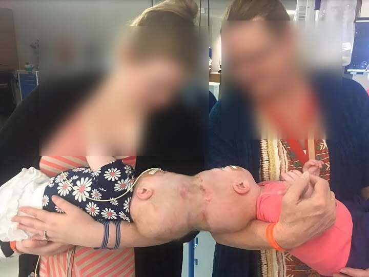 These Siamese sisters were born with their heads