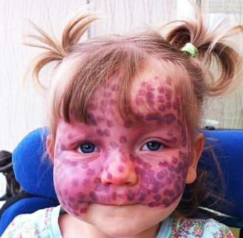 Parents respond to strangers who jump to hurtful conclusions because of their daughter’s rare skin disease