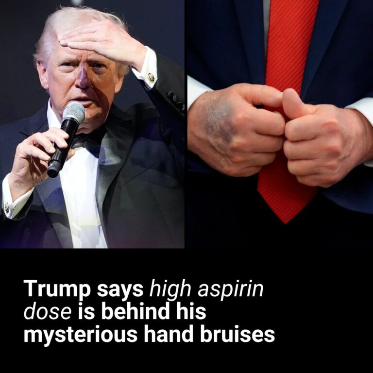 Donald Trump reveals what is behind his mysterious hand bruises
