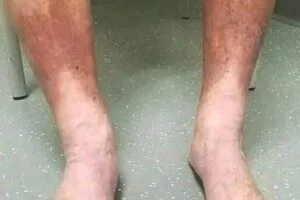 Swollen Feet: Common Causes, Warning Signs, and When to Seek Medical Advice