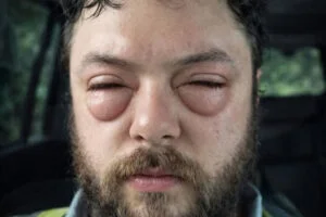 Bumps on the Eye: Causes, Symptoms, and When to Seek Care