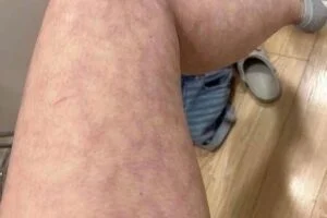 When Warmth Leaves a Mark: Understanding Heat-Related Skin Changes